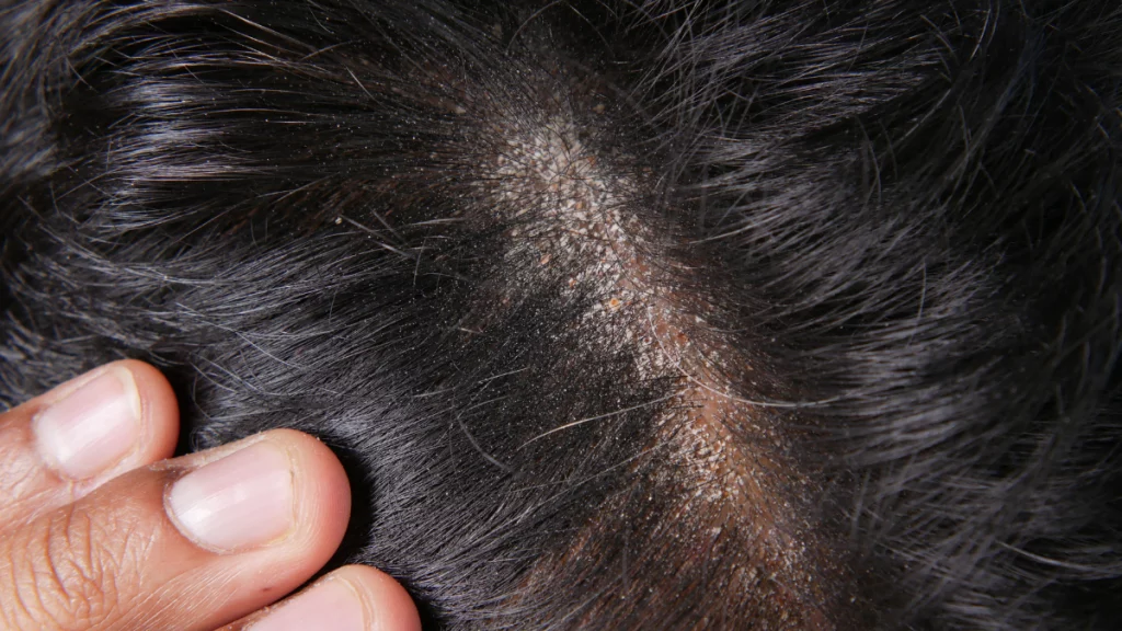 Dermite séborrheique : Quelles conséquences sur la perte de cheveux ?