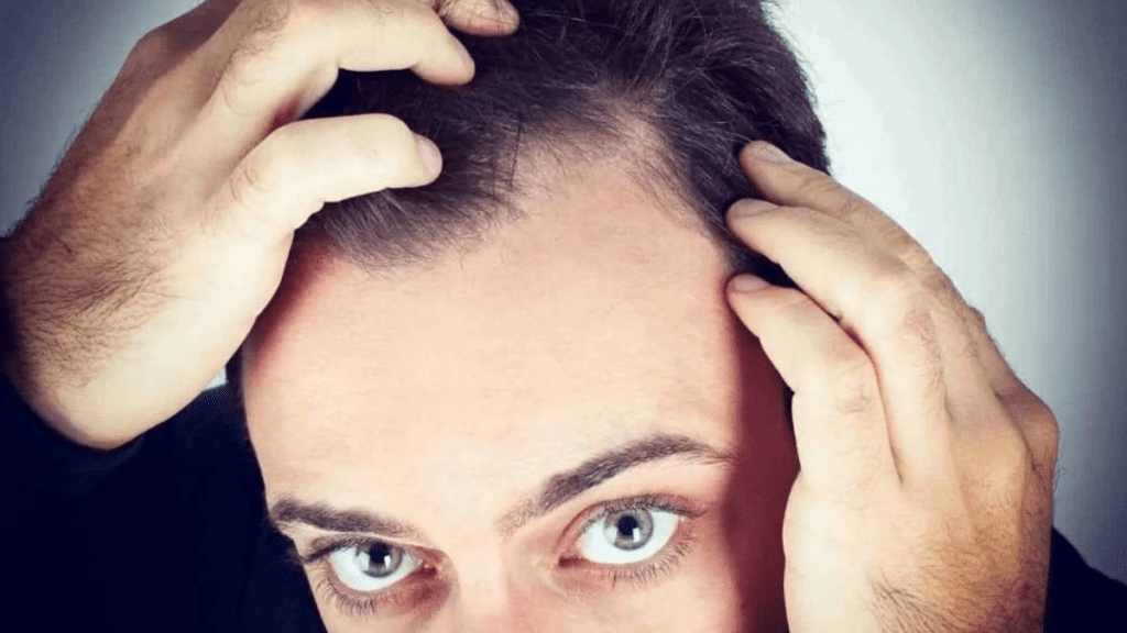 Début de calvitie : Que faire quand on commence à perdre ses cheveux ?